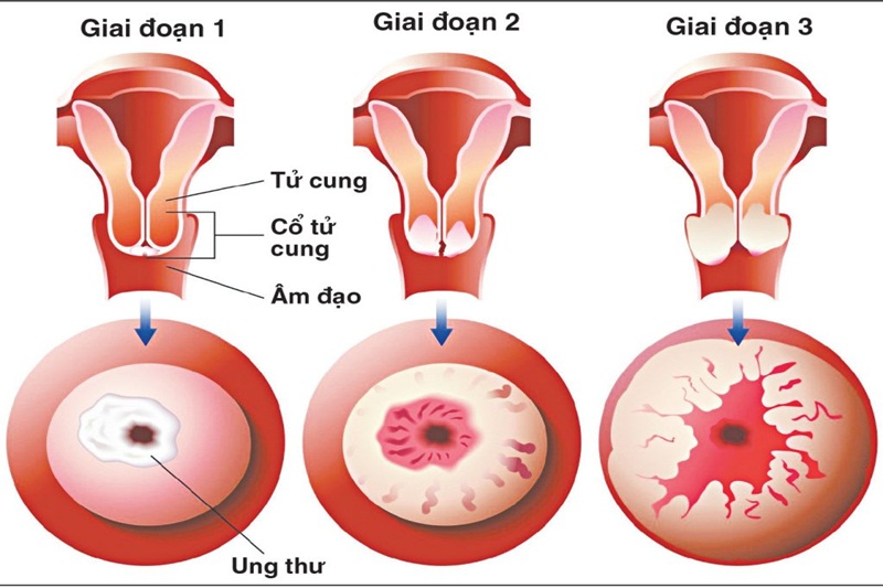 KHÁM PHỤ KHOA - BỆNH LÝ VIÊM- UNG THƯ CỔ TỬ CUNG