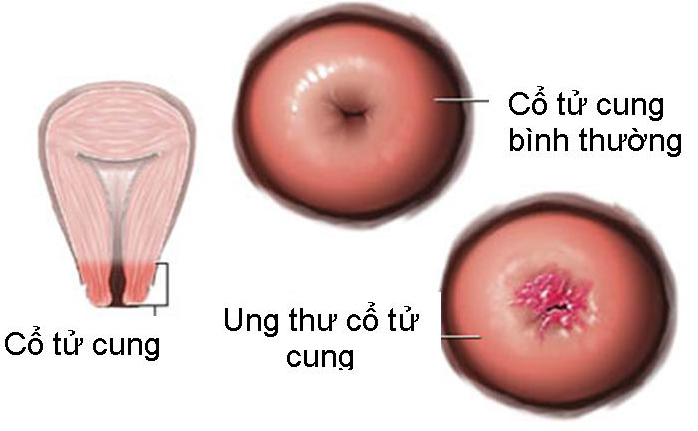 ĐỐT ĐIỆN CỔ TỬ CUNG